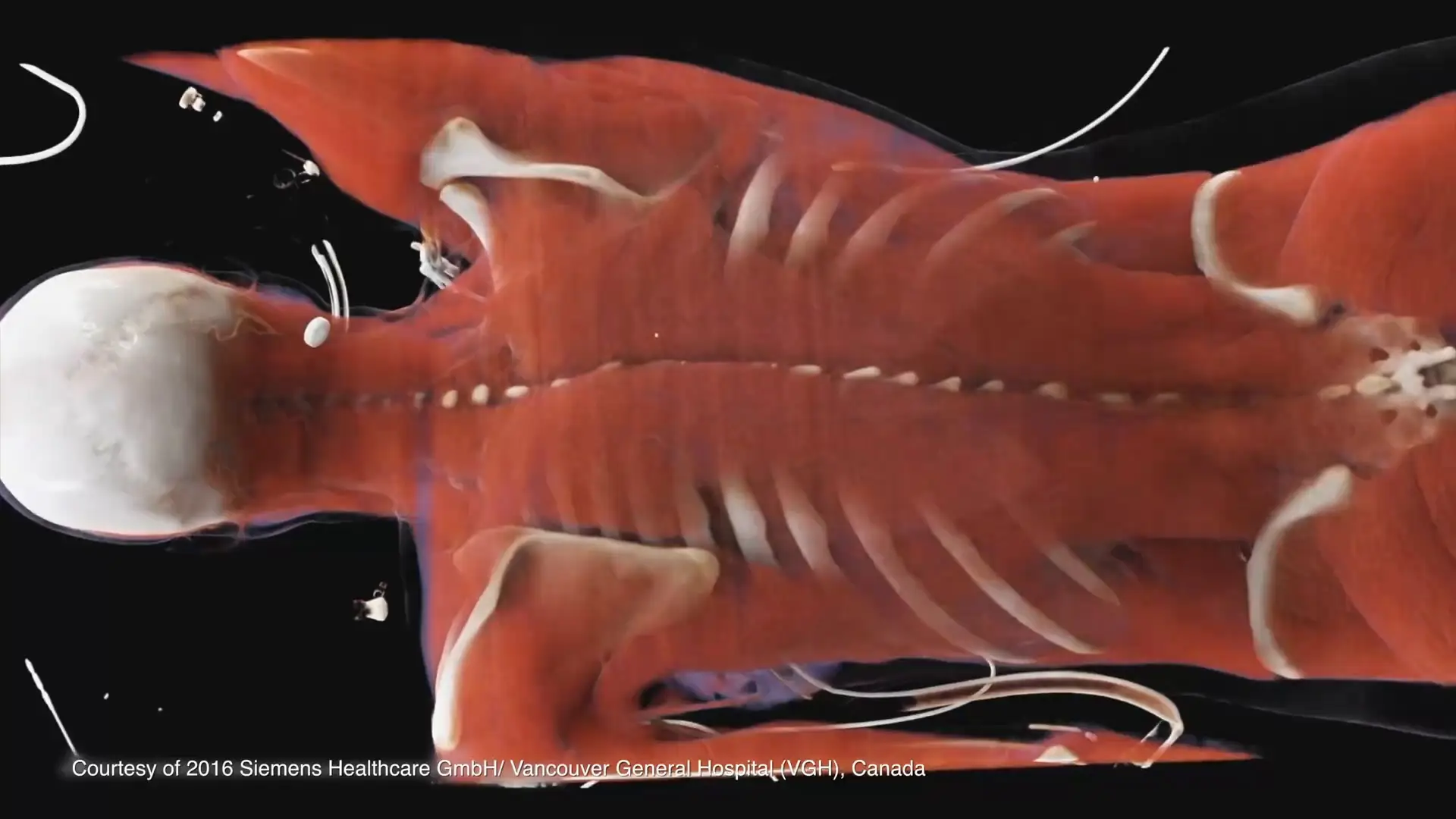 NHK - Breakthrough: Fixing a Broken Heart (2019)