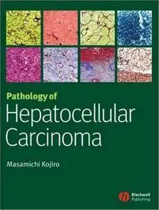 Pathology of Hepatocellular Carcinoma