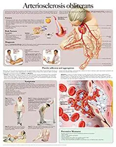 Arteriosclerosis obliterans e-chart: Full illustrated