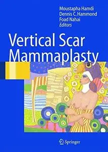 Vertical Scar Mammaplasty