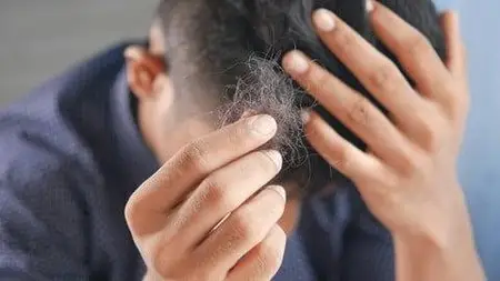 How To Heal Alopecia Holistically