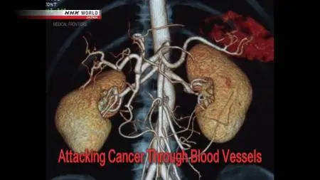 NHK - Medical Frontiers: Attacking Cancer Through Blood Vessels (2018)