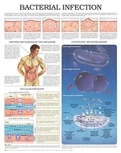 Bacterial Infection e chart: Full illustrated