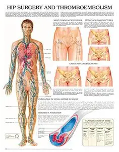 Hip surgery and thromboembolism e chart: Full illustrated