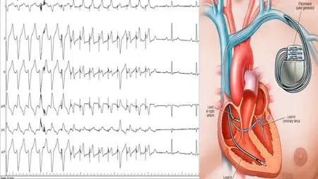 Certificate In Pacing Devices (Pacemaker & Icd) Part 1