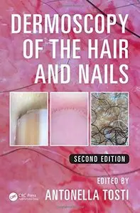 Dermoscopy of the Hair and Nails, Second Edition