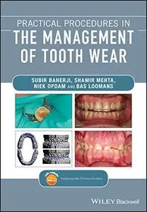 Practical Procedures in the Management of Tooth Wear