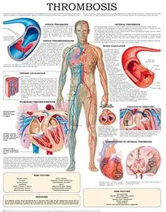 Thrombosis e-chart: Quick reference guide