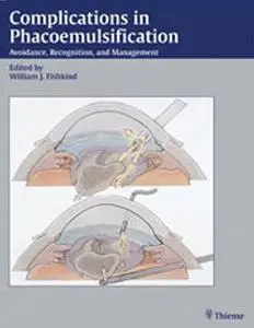 Complications in phacoemulsification : avoidance, recognition, and management