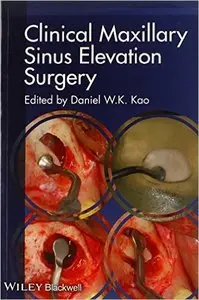 Clinical Maxillary Sinus Elevation Surgery (repost)