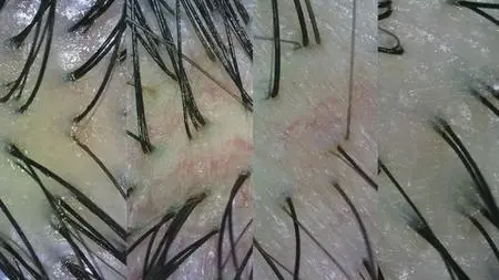 Scalp Type Identification