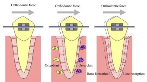 Master, Wanted & Unwanted Tooth Movement In Orthodontics