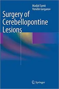 Surgery of Cerebellopontine Lesions