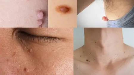 Skin Tags & Dark Spot Removal Masterclass For Aestheticians