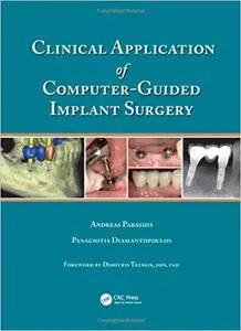 Clinical Application of Computer-Guided Implant Surgery