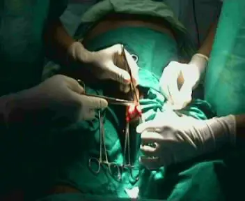 Operative Surgery – Circumcision