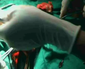 Operative Surgery – Circumcision