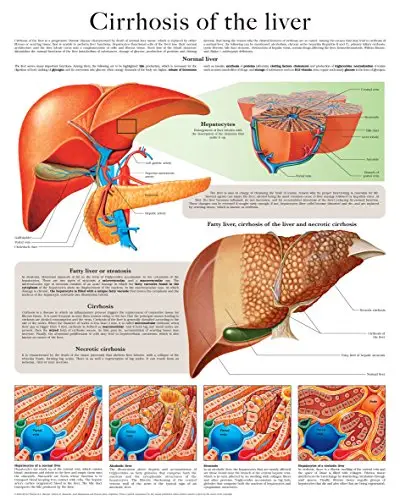 Cirrhosis of the liver e-chart: Full illustrated / AvaxHome