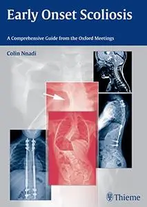 Early Onset Scoliosis: A Comprehensive Guide from the Oxford Meetings (Repost)