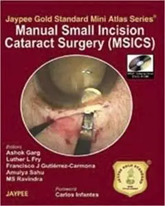 Manual of Small Incision Cataract Surgery