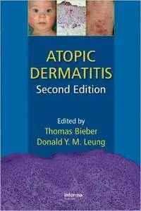 Atopic Dermatitis, Second Edition