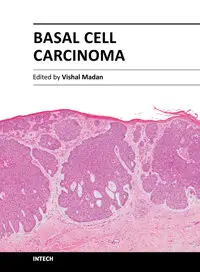 Basal Cell Carcinoma by Vishal Madan