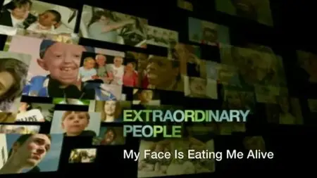 Channel 5 - Extraordinary People: My Face is Eating Me Alive (2013)