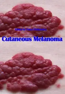 "Cutaneous Melanoma" ed. by Paweł Pietkiewicz