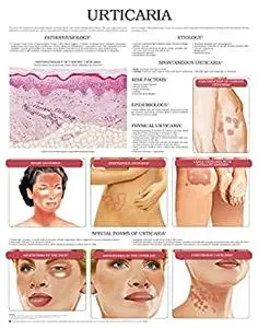 Urticaria e chart: Full illustrated
