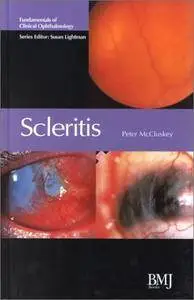 Scleritis: Fundamentals of Clinical Ophthalmology