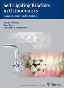 Self-ligating Brackets in Orthodontics