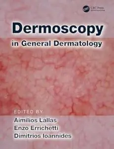 Dermoscopy in General Dermatology (Repost)