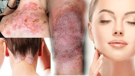 Certificate In Skin Disorders Alternative Therapy Treatment