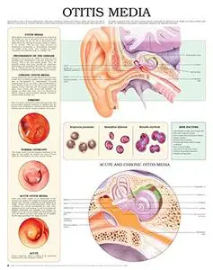 Otitis Media e chart: Full illustrated