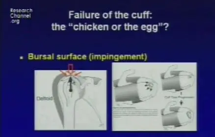 Video of "Shoulder Arthroscopy & Rotator Repair" 2009