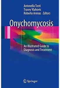 Onychomycosis: An Illustrated Guide to Diagnosis and Treatment [Repost]
