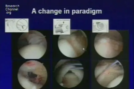 Video of "Shoulder Arthroscopy & Rotator Repair" 2009