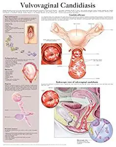 Vulvovaginal Candidiasis e-chart: Full illustrated