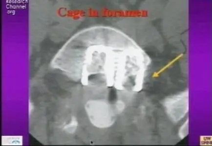 Video of "Outlook on Disc Replacement" 2009