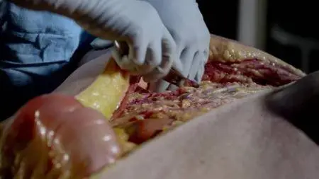 Obesity: The Post Mortem (2016)