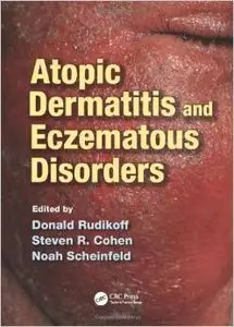 Atopic Dermatitis and Eczematous Disorders