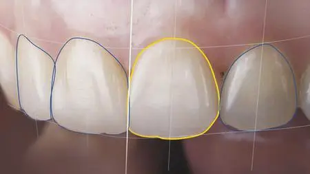 Anterior Crowns And Veneers