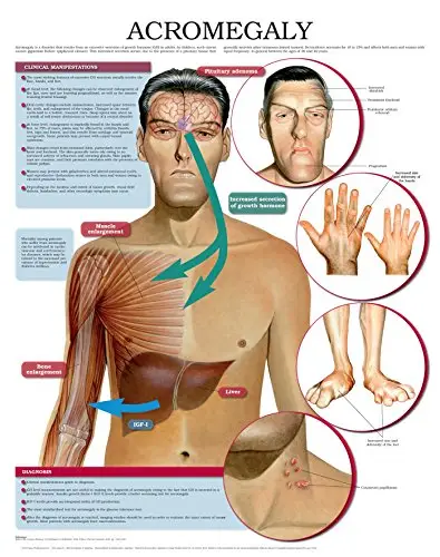 Acromegaly e chart: Full illustrated / AvaxHome