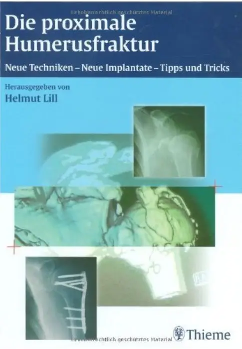 Die proximale Humerusfraktur: Neue Techniken - neue Implantate - Tipps und Tricks