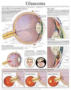 Glaucoma e chart: Full illustrated