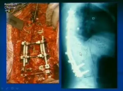 Video of "Specific Indications for Spine Surgery" 2009
