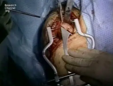 Video of "Shoulder Replacement For Active People" 2009