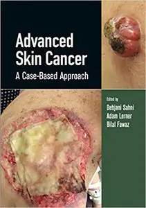 Advanced Skin Cancer: A Case-Based Approach