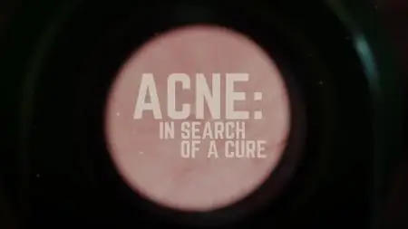 Acne In Search Of A Cure (2020)