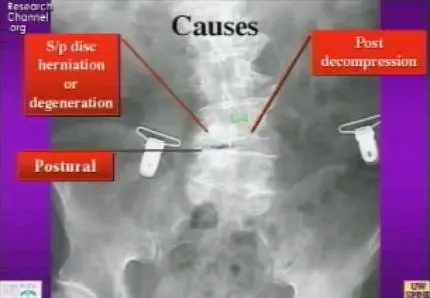 Video of "Surgery for the Aging Spine" 2009